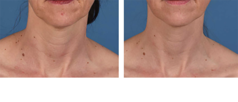 Hero Results 1-new | Visia Special Offer