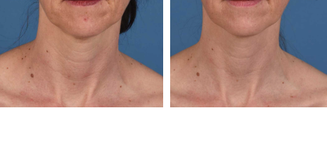 Hero Results 1 | Visia Skin Nashville & Gallatin