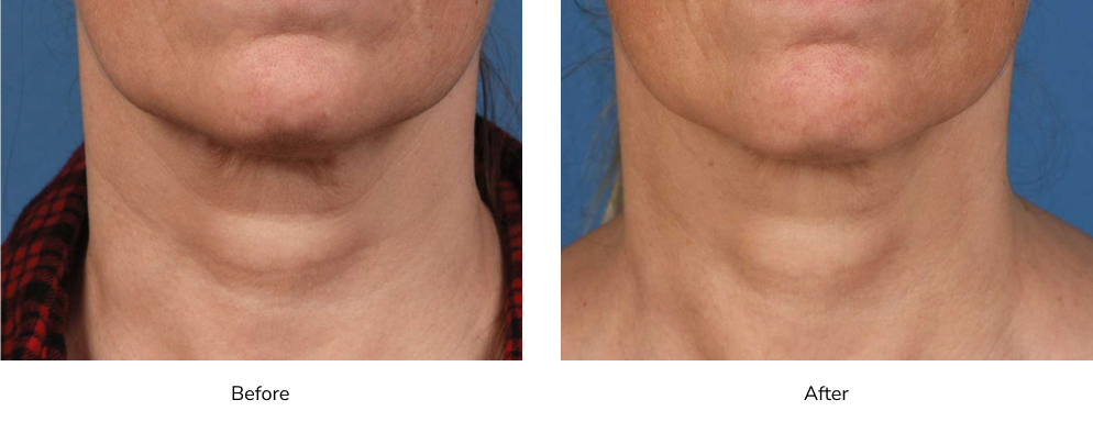 Results 1 | Visia Skin Nashville & Gallatin