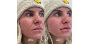 Lip Filler Before and After Result Nashville & Gallatin